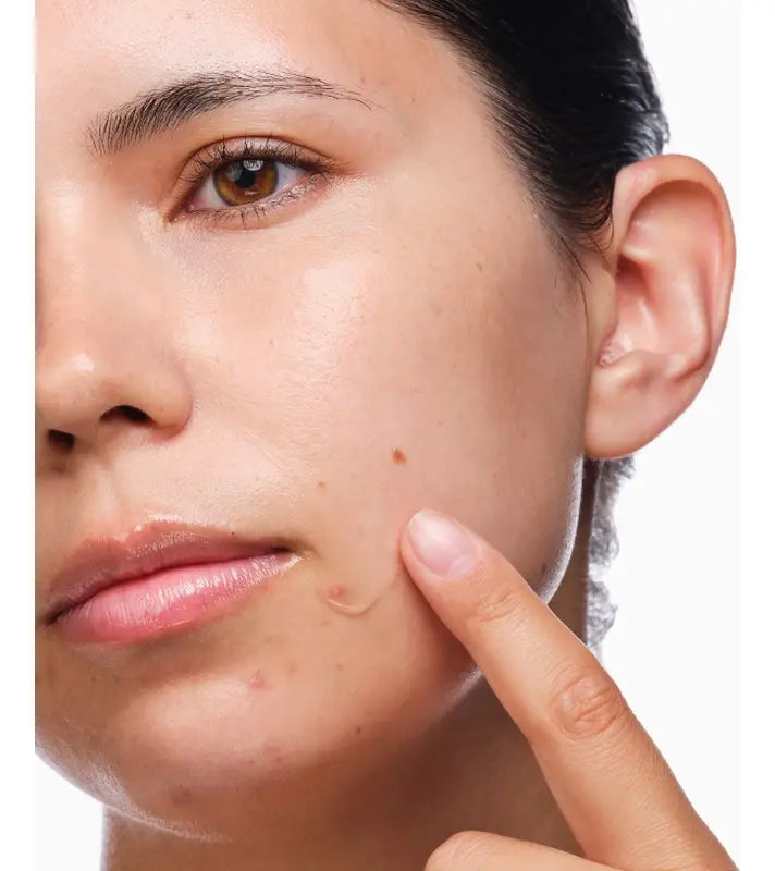 The Ordinary Kit De Tratamento Para Acne (3 itens)